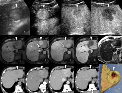 Contrast Agents for Hepatocellular Carcinoma Imaging: Value and Progression